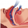 研究揭示了增强睡眠呼吸暂停相关问题治疗的有前途的方法
