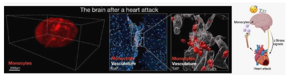 研究发现心脏病发作后 心脏向大脑发出信号 促进睡眠以恢复健康